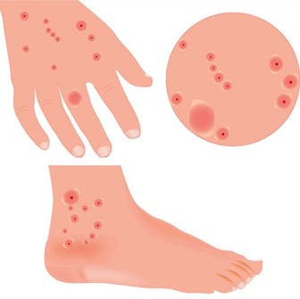 Bidmærker fra væggelus Bidmærker fra væggelus i form af kløende, røde knopper